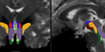 AI algorithm allows monitoring of important white matter pathways | MIT Information