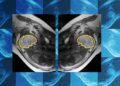 Why educating AI about symmetry might make prenatal analysis extra dependable | MIT Information
