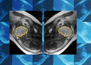Why educating AI about symmetry might make prenatal analysis extra dependable | MIT Information